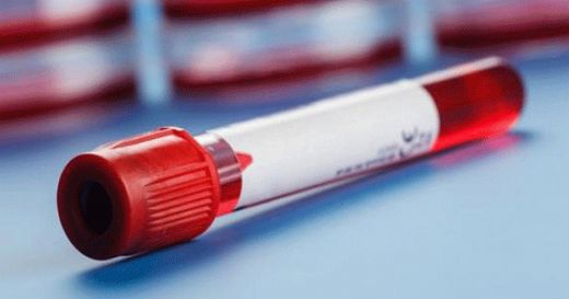 Ferritin Fazlalığı Belirtileri ve Tedavisi